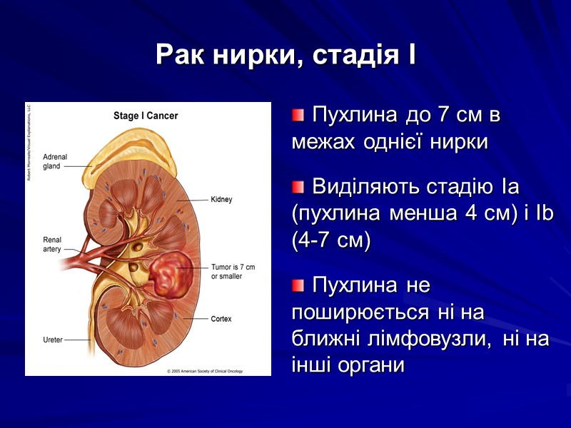 Рак нирки, стадія І  Пухлина до 7 см в межах однієї нирки 